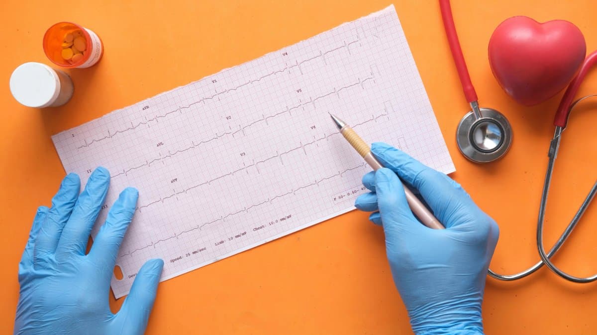 Atrial Fibrillation and Stroke Risk: What You Need to Know