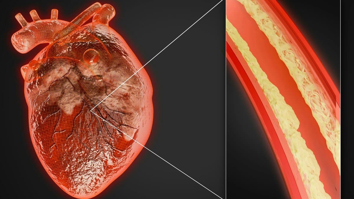 Plaque, Atherosclerosis & Silent Heart Disease: What You Cannot Feel Can Still Kill You