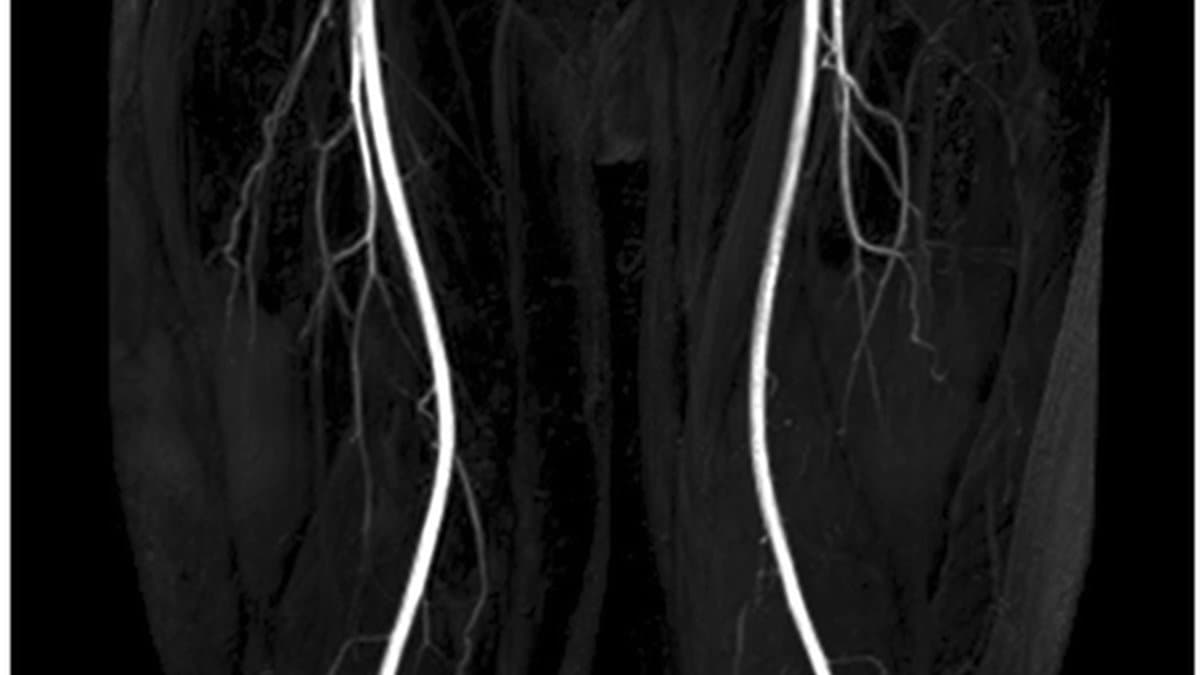5 Warning Signs of Peripheral Artery Disease You Should Not Ignore