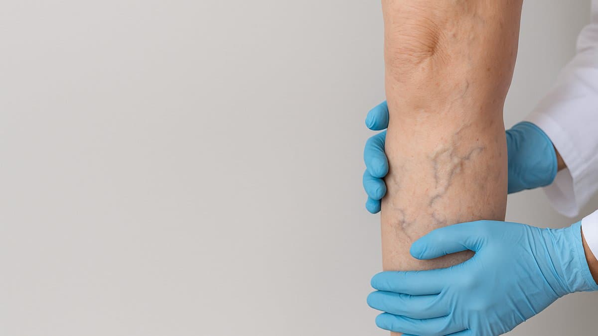 Varicose Veins of the Legs
