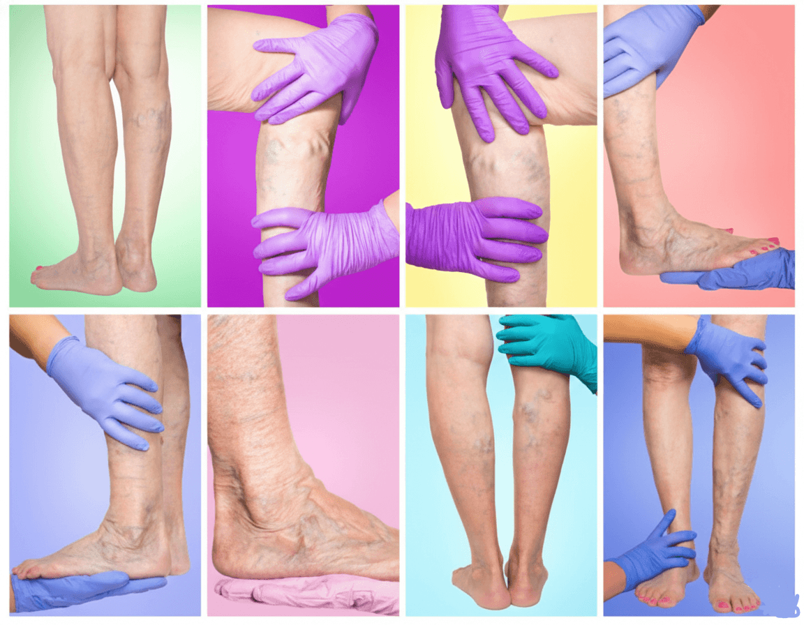 Venous care — varicose vein examination