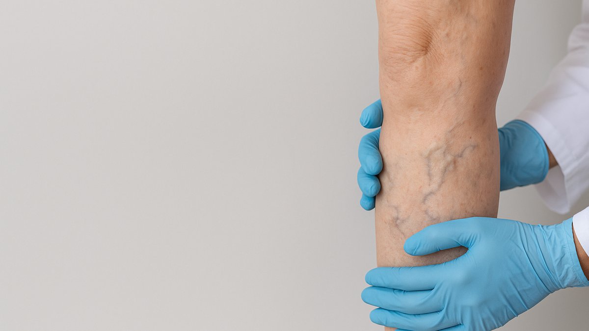 Close-up of varicose veins on a patient's leg